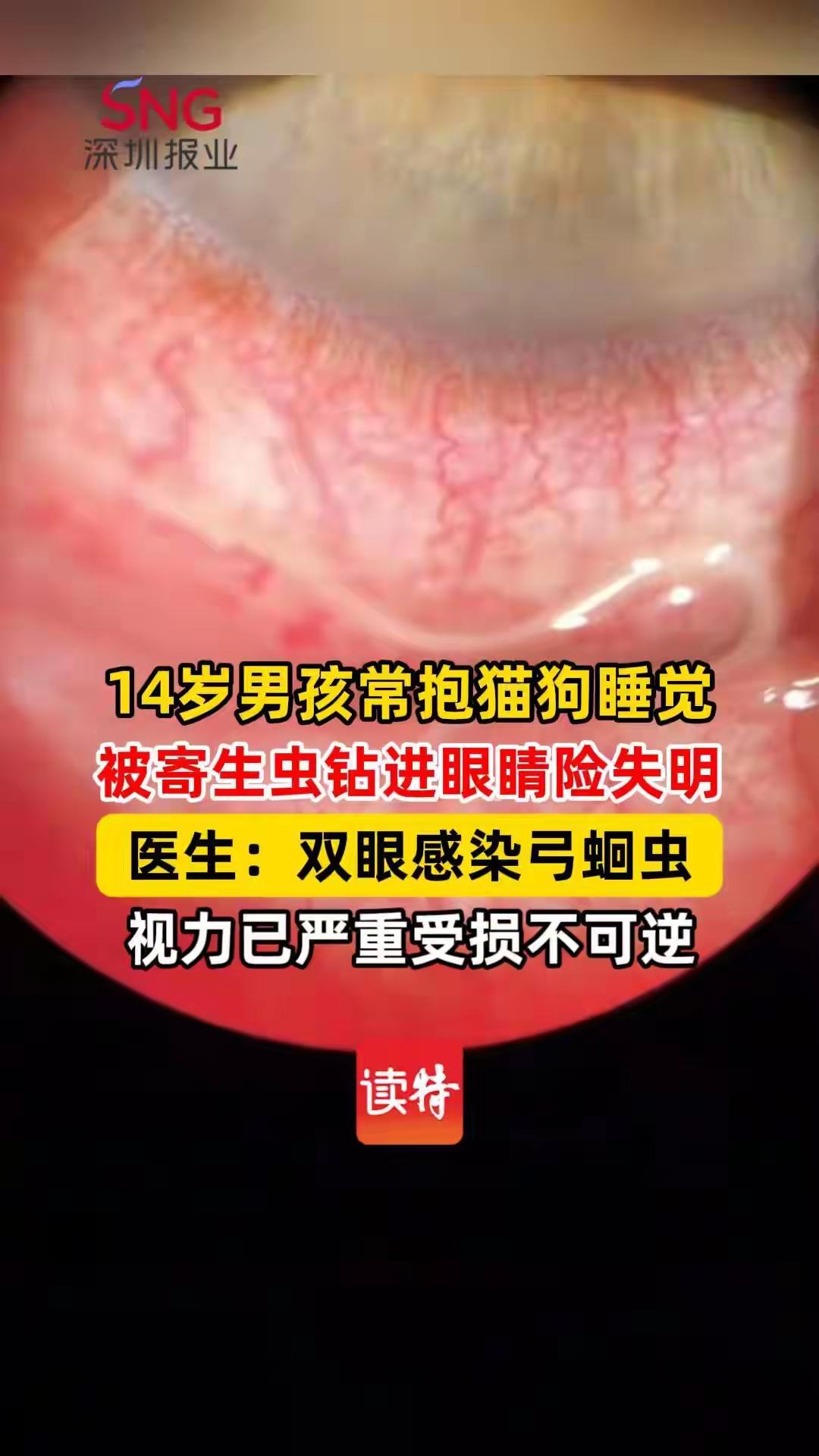 男孩与猫狗同吃同睡感染弓蛔虫险失明男孩和猫狗同吃同睡感染弓蛔虫差点失明，这事儿