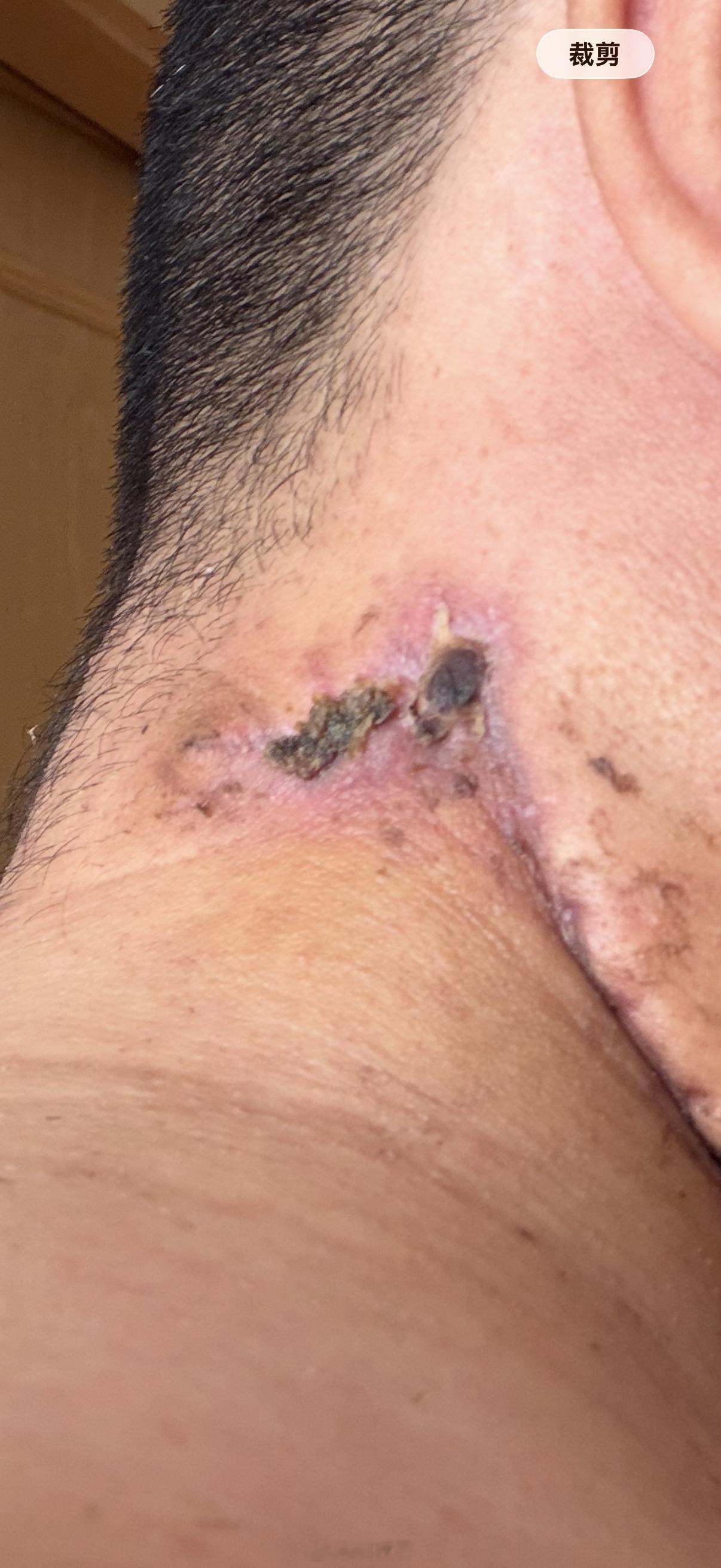 去肿瘤专科医院找专家看了看治疗方案，需要住院做放化疗了，估计住院2个月，唉，熬吧