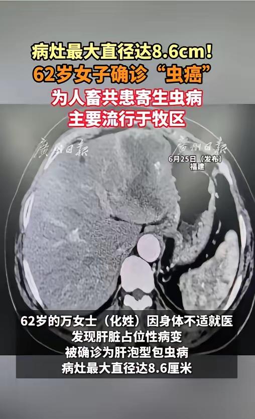 “给所有养宠家庭敲醒警钟！”福建一名62岁的万女士，就因为常年和宠物零距离相处，