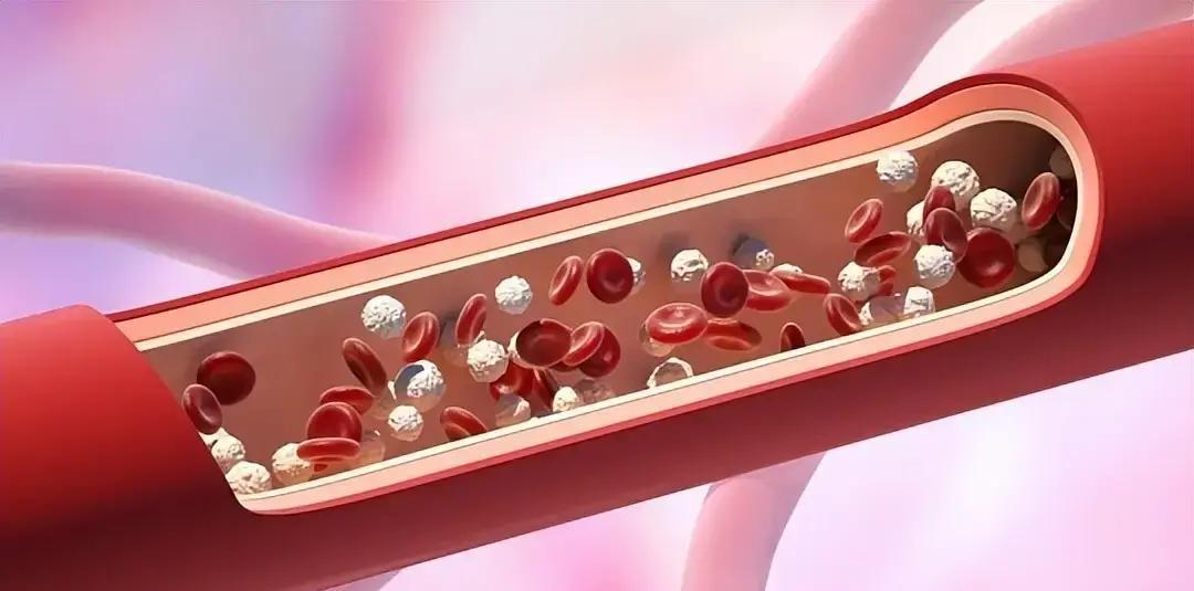 最近几年，心内科门诊里不少人拿着冠脉造影报告，看到血管狭窄85%就慌了，总觉得不