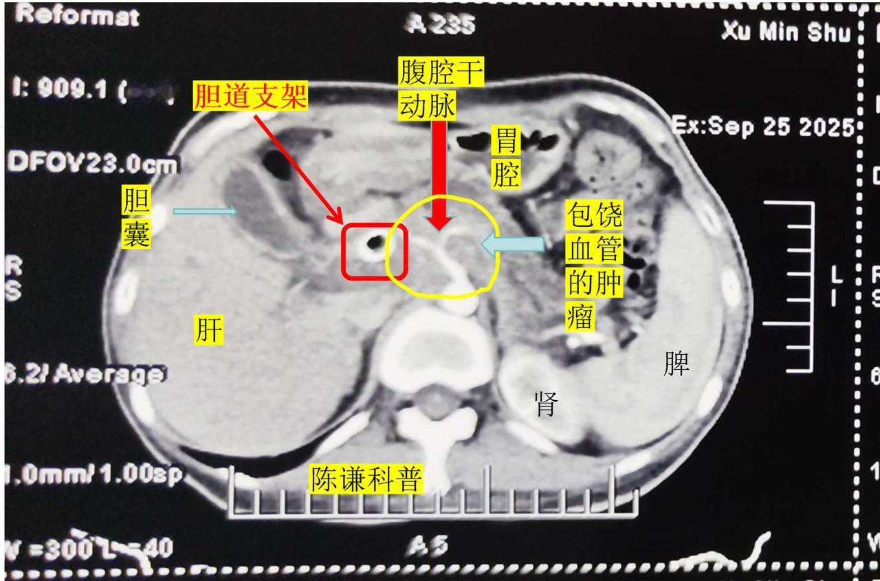 胰腺癌晚期患者如何缓解疼痛?胰头癌是胰腺癌中最常见的类型，由于肿瘤很容易侵犯胆