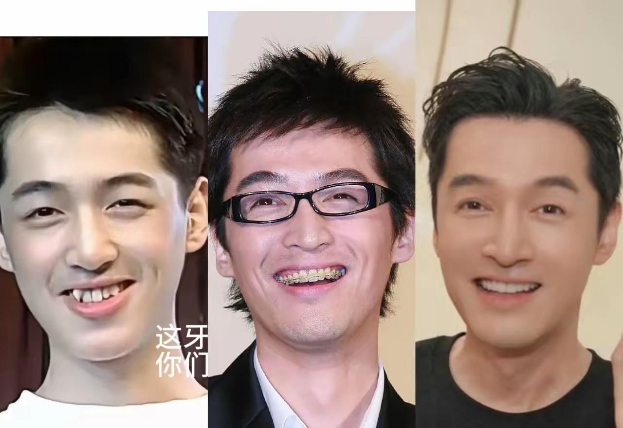 胡歌当年那口牙真是一言难尽，矫正了后，让人羡慕不已。难怪有网友说，胡歌这辈子做