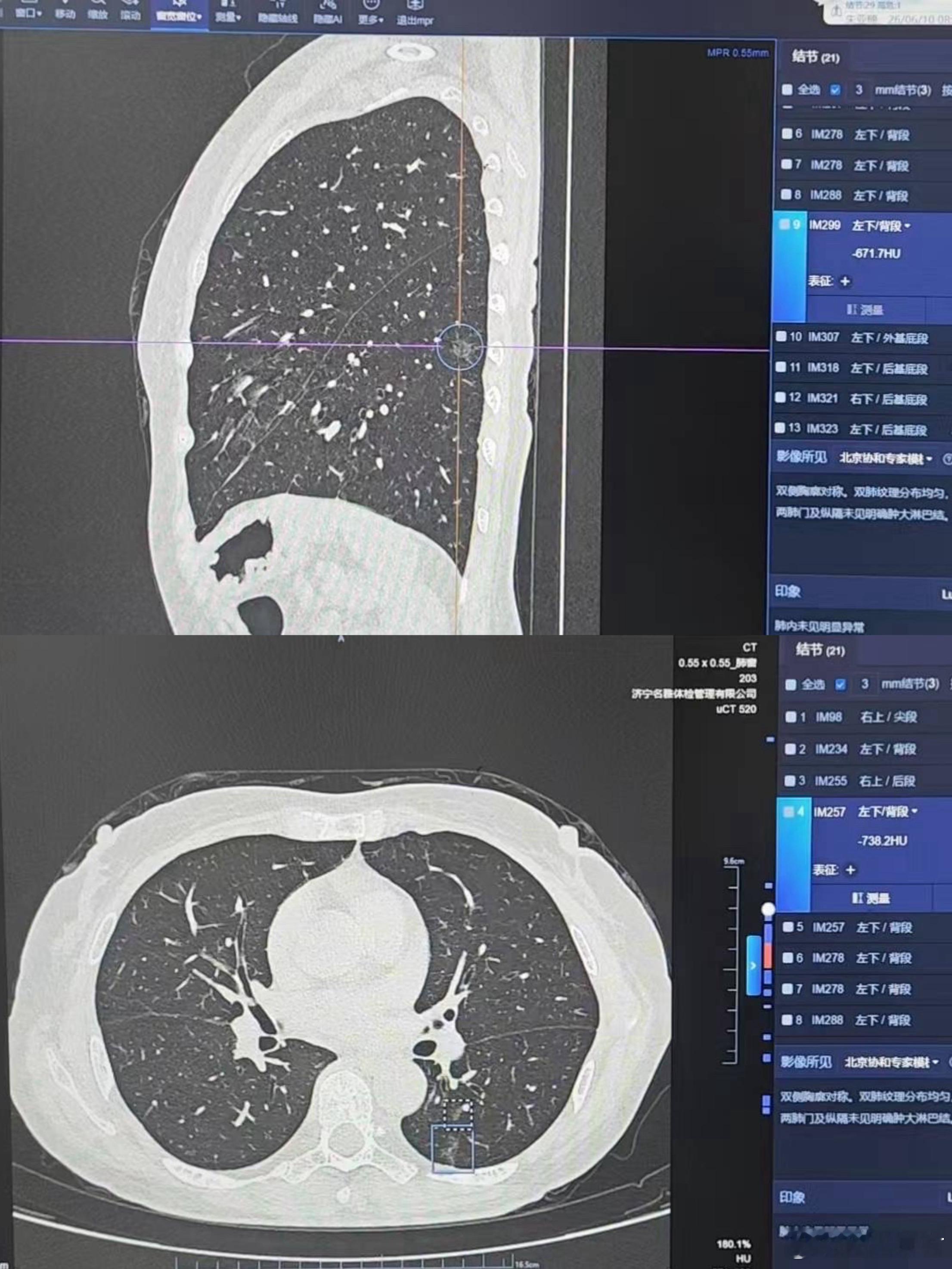 一位患者主因久咳来诊。今年6月体检时发现肺部多发结节：最小约2毫米，最大约13毫米。服中药后咳嗽好转