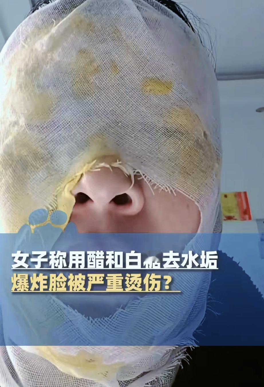 “万万没想到！”近日，河北邯郸一女子用醋和白糖去水垢爆炸脸被严重烫伤一事引起关注