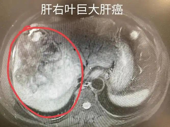别再被误导！肝癌3个常见误区，很多人踩坑还不自知平时接诊时，发现很多人对肝癌