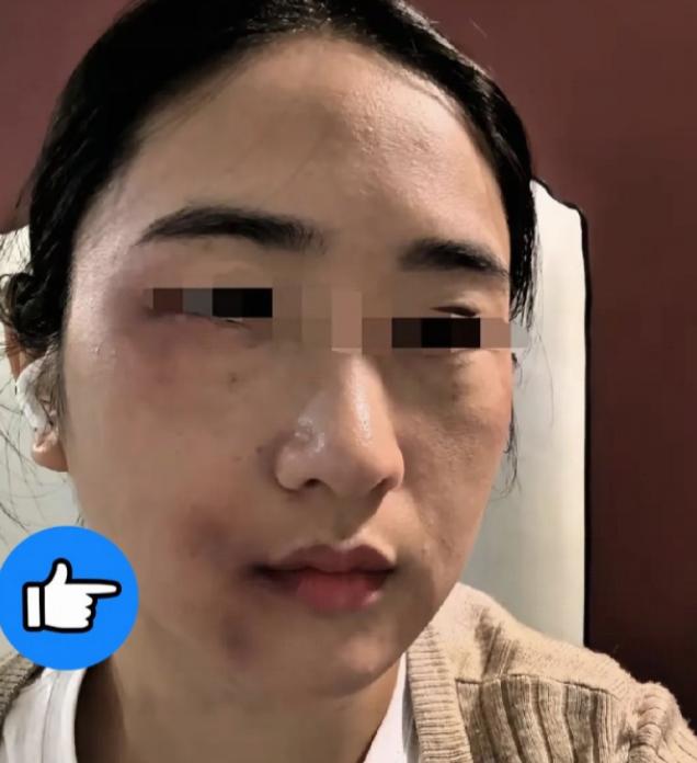 女子遭随性发火的丈夫殴打后，弟弟得知情况，拿起家中的一根钢管赶到姐姐家。丈夫开门
