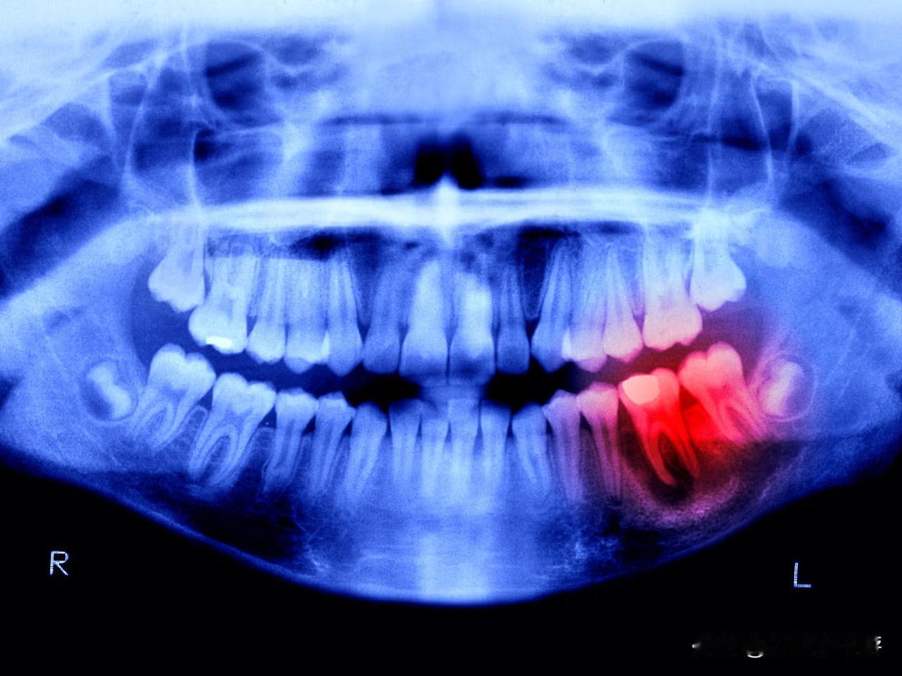 日本“牙齿再生药物”已开启人体试验，目标是在2030年实现上市。日本科学家正