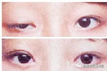 眼睑下垂是怎么回事?