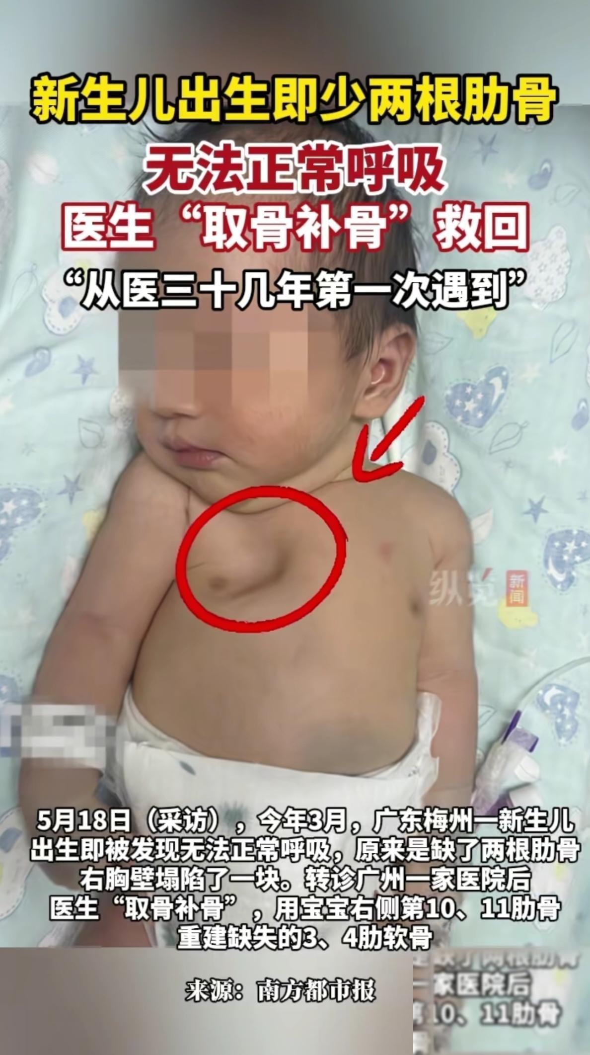 5月18号那天刷到一个让人心揪了一下的消息。广东梅州一个刚出生的宝宝，一落地情况