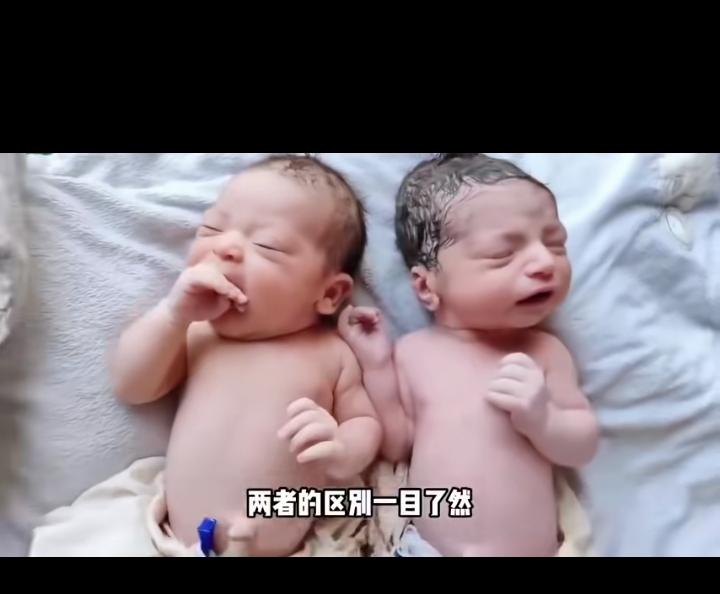这两个宝宝有一个是唐氏综合征，大家能看出来是哪个么？