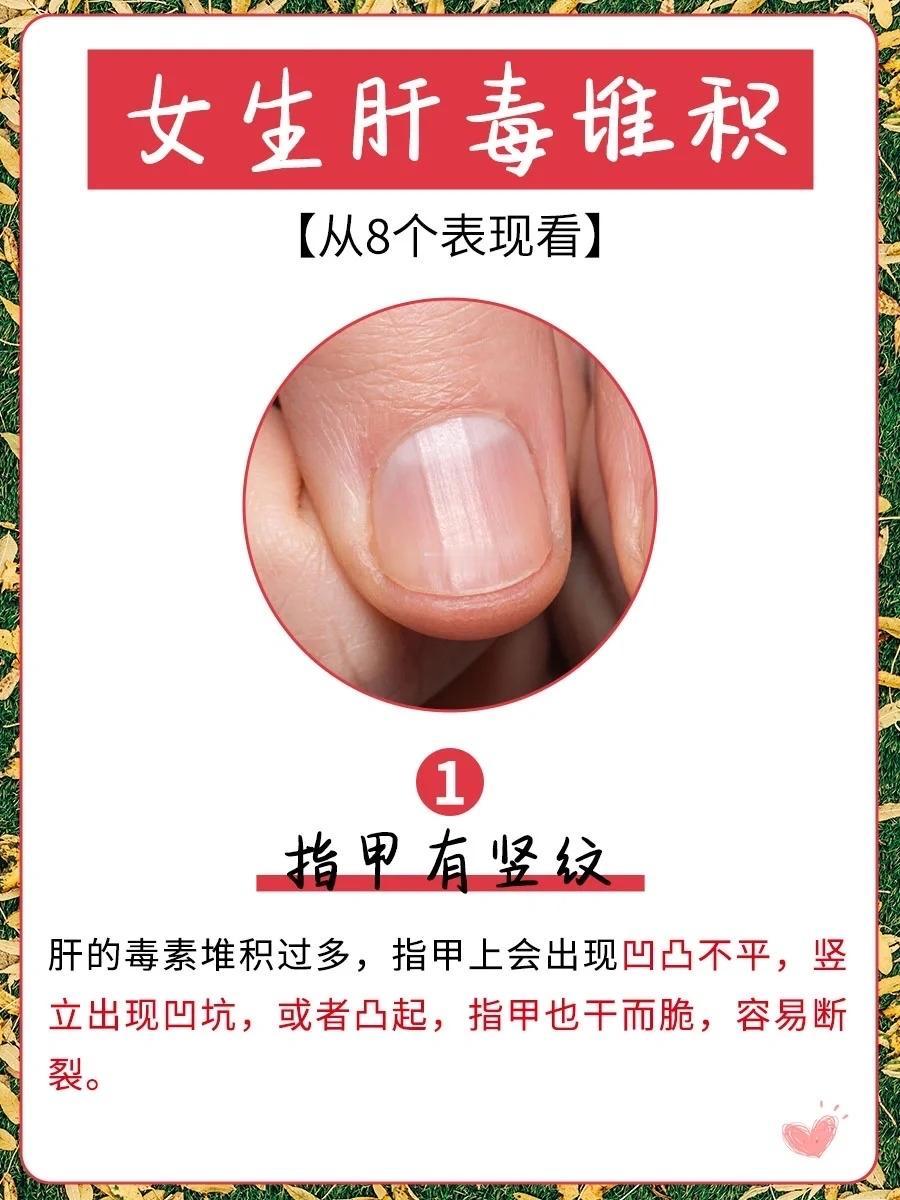 很多人总觉得肝疼才是出事，却不知道：指甲和眼睛，早就替肝脏喊了无数次救命！肝