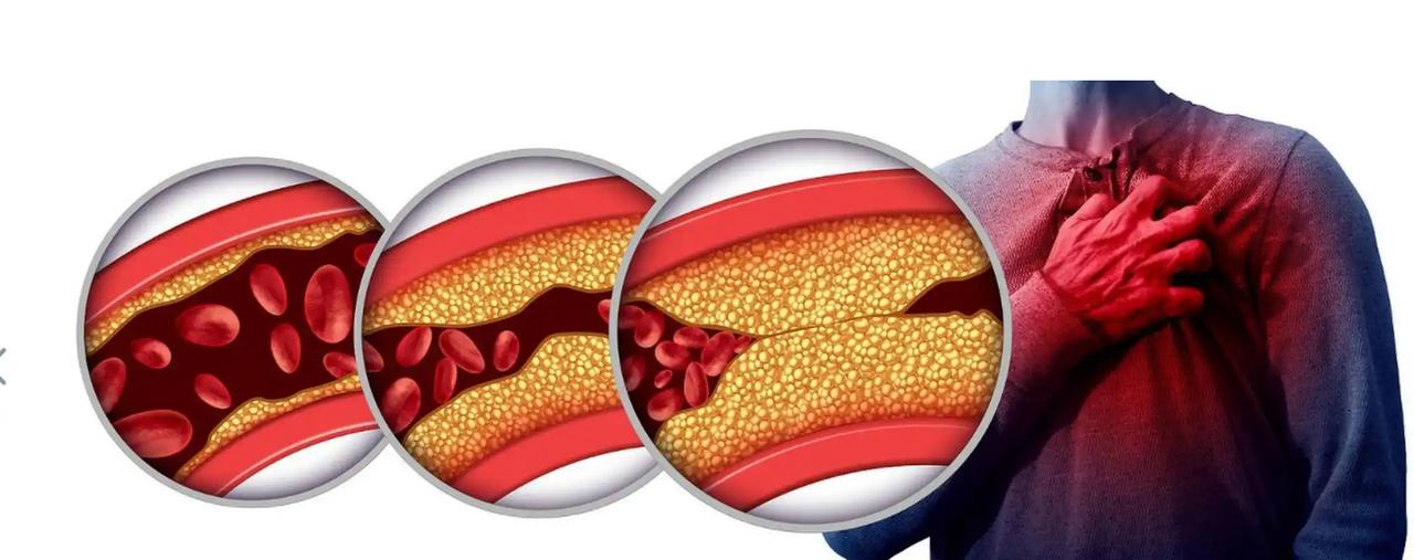 血管斑块能逆转吗？血管科医生直言：做好这5件事相当于给血管“洗个澡”话说