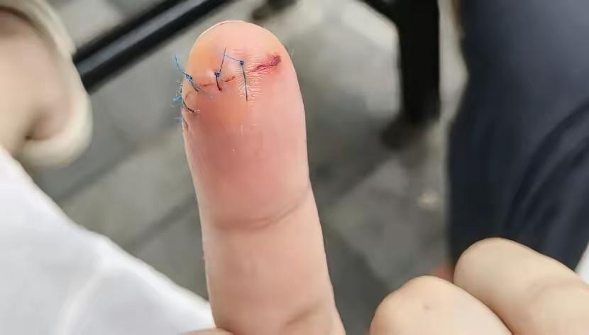 6月28日，一名北京网友在社交平台发文吐槽就医经历，称自己手上只有大概一厘