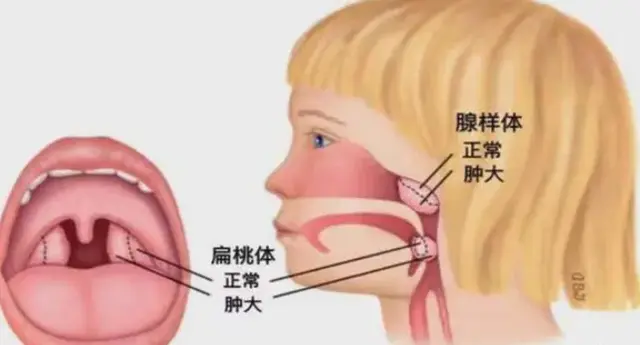 为什么腺样体肥大的孩子, 容易伴有鼻炎、鼻窦炎、中耳炎?