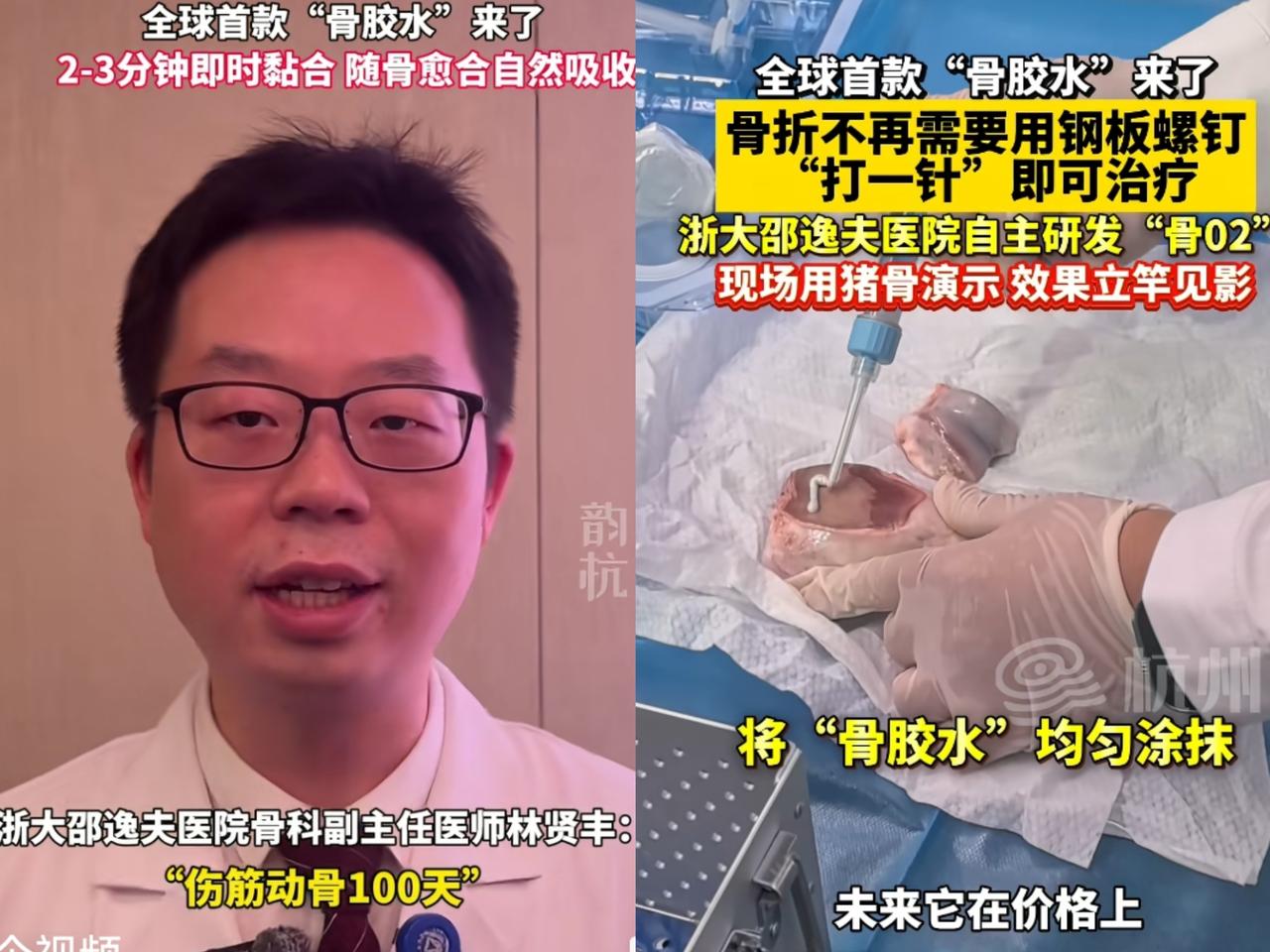 这事可太长脸了！不光国内传遍了，全球都在盯着呢！谁懂啊，以后骨折不用遭打钢钉