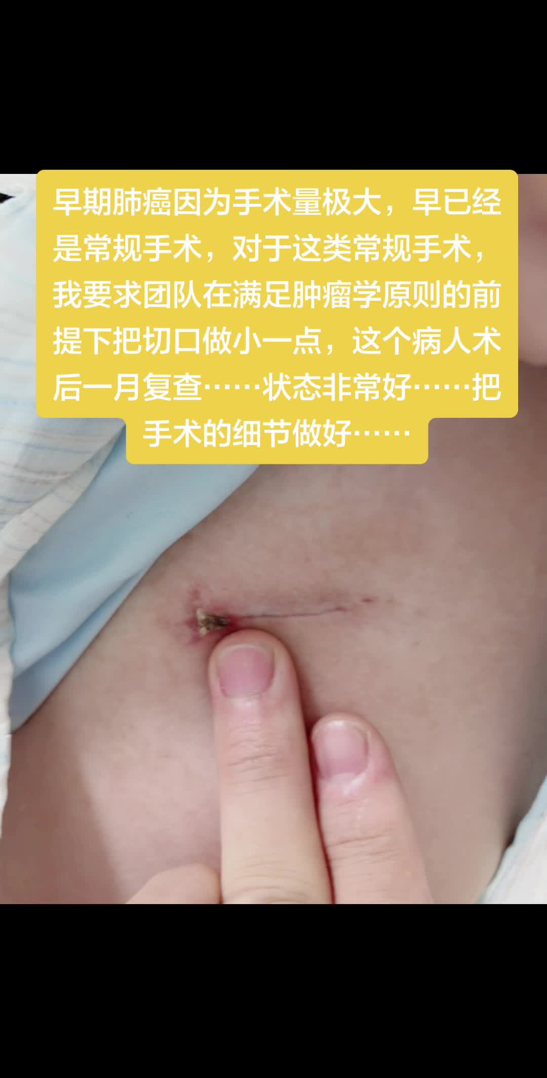 早期肺癌因为手术量极大，早已经是常规手术，对于这类常规手术，我要求团队...