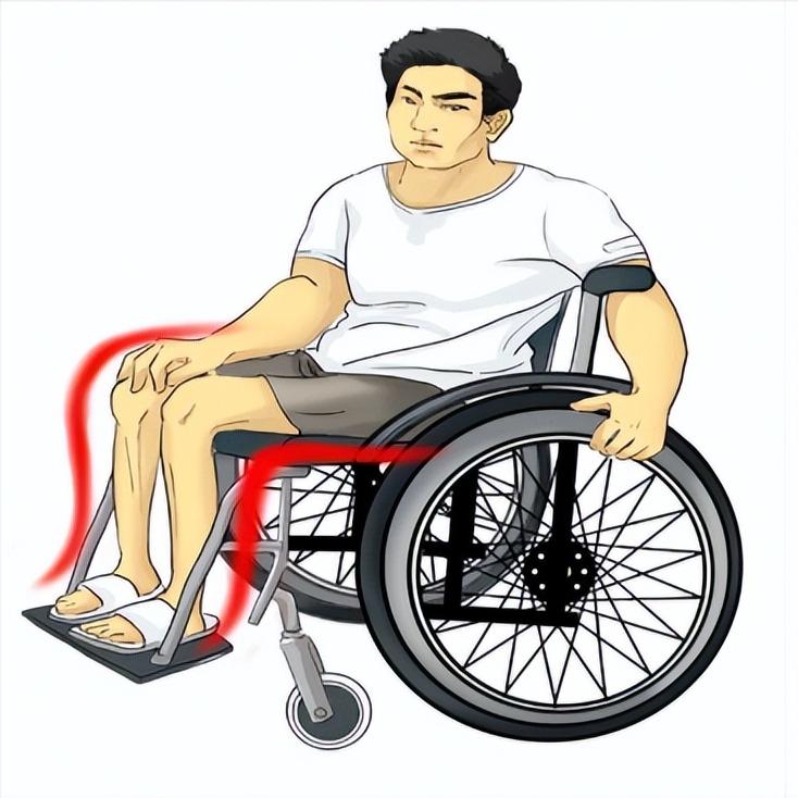 脊髓损伤后这5个变化，出现一个就是好消息！1、感觉的“回归”损伤后部分皮肤可