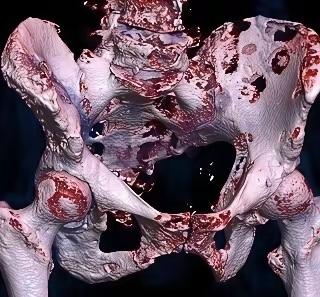 ​这是一张骨癌患者的照片，看上去这位患者的骨架已经被癌细胞吞噬得千疮百孔，估计他