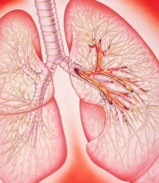 慢性支气管炎——我有一张“断根方”，从医30年珍藏，今日公开分享！不少中老年