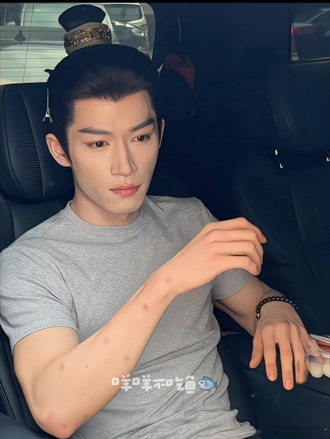 王星越这胳膊上密密麻麻的圆点是啥？蚊子🦟干的？？？？​​​