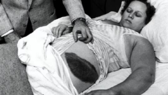 1954年，国外一名女子正在熟睡时，突然感到腹部和大腿传来刺痛，像是被什么东西擦