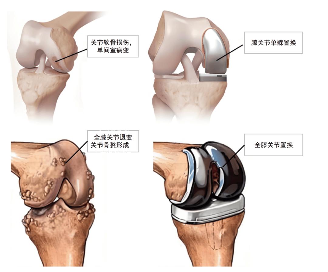 得了骨关节炎，什么时候该考虑膝关节置换？很多朋友都被这个问题难住🤔其实核心判