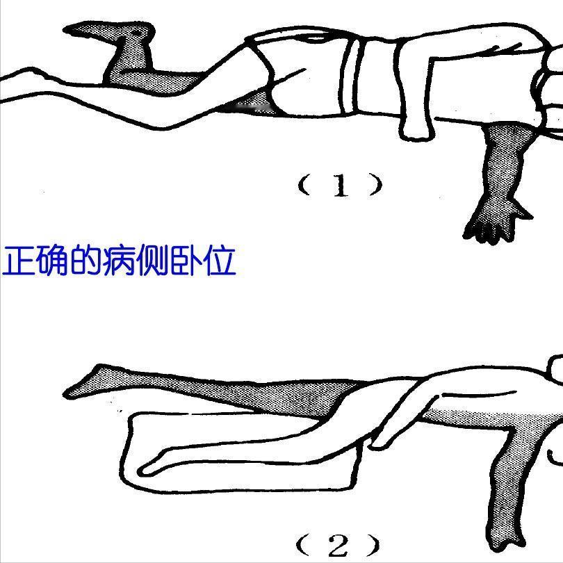 偏瘫卧位不对，后续锻炼都白费！1.半卧位半卧位是大家最容易犯的错误，总认为