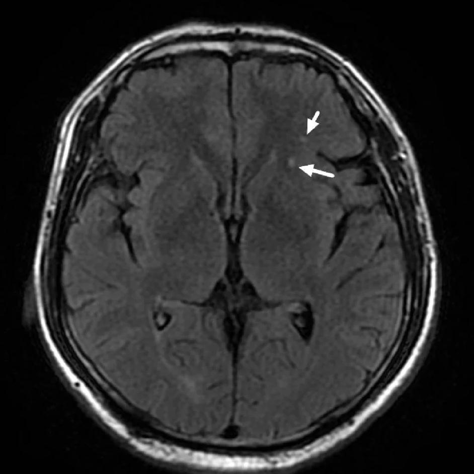 腿部有这4个表现，小心是脑梗预警别以为脑梗只跟脑袋有关，腿上出现这些信号，可