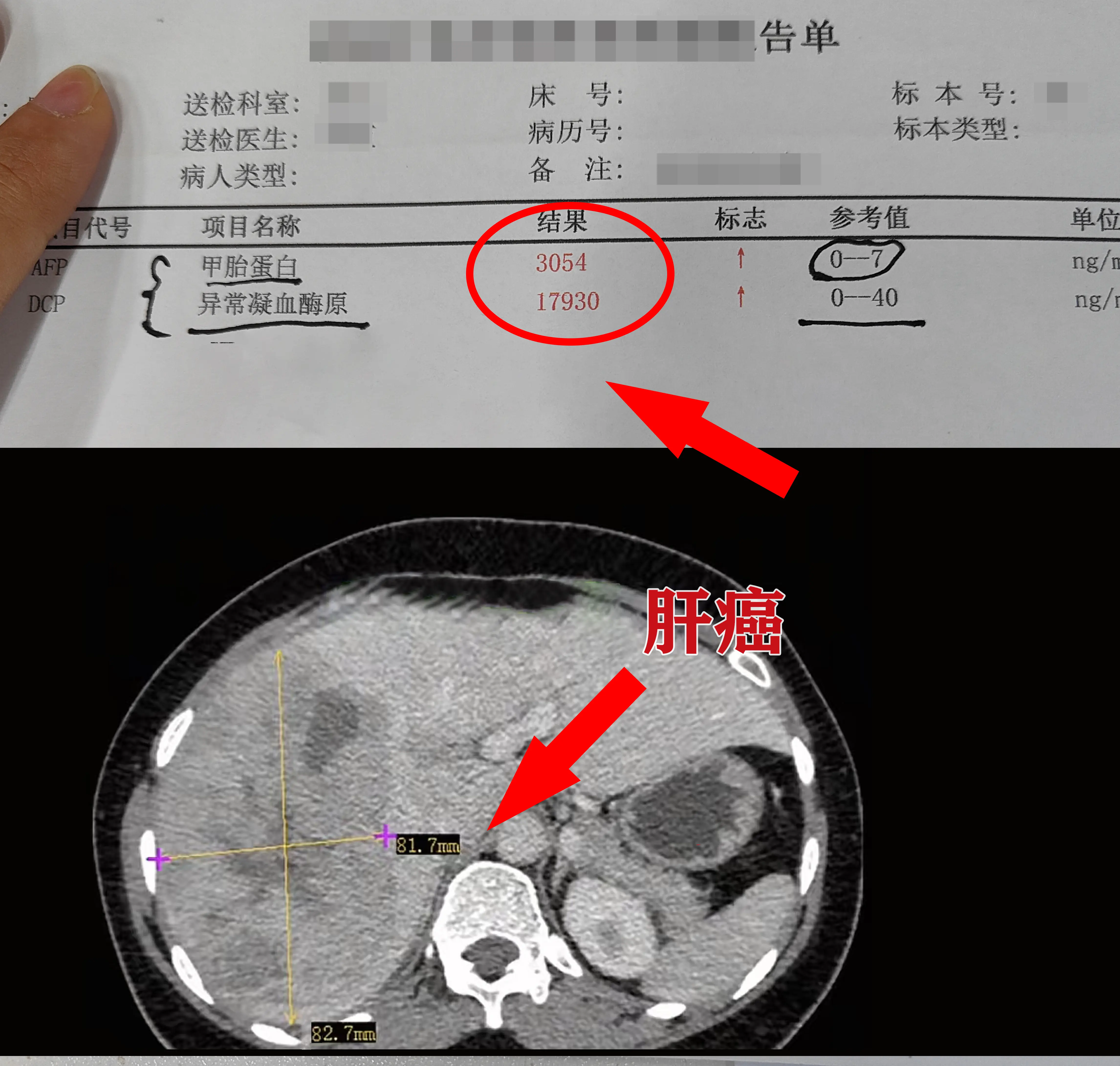 这是前两天因为肝区疼痛才来就诊的一位患者。一查转氨酶、胆红素都200多...