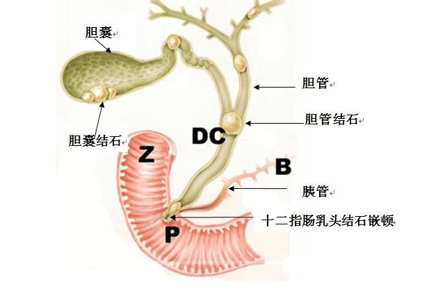 胆结石只能切胆治疗吗? 看看这些能不能帮到你