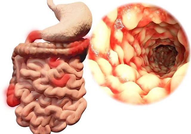 结肠癌不会无缘无故来? 医生研究: 得肠癌的人, 背后或有5原因