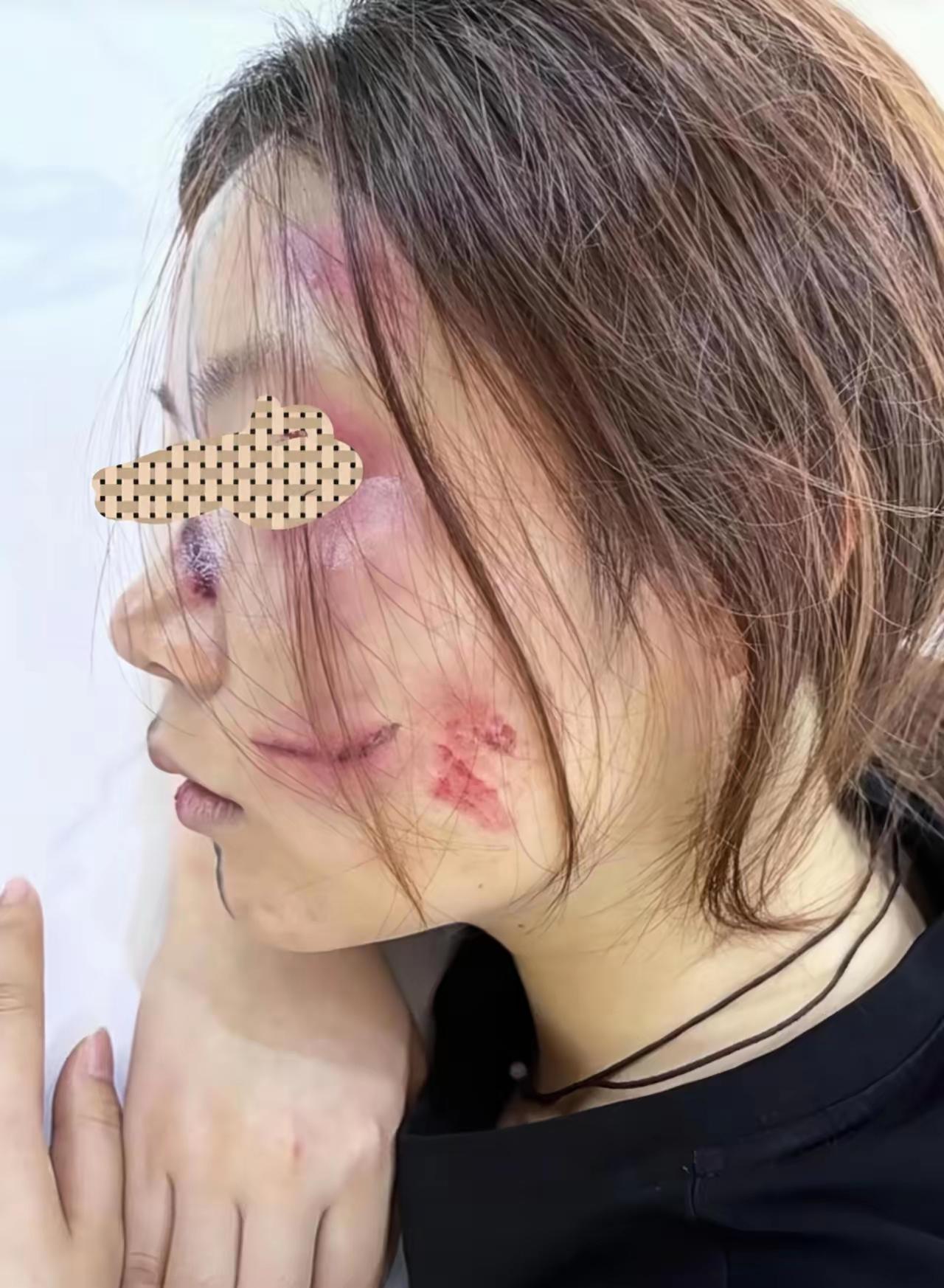 现世报啊，家暴妻子的男子突然查出肝癌晚期，而妻子此刻脸上面目全非，布满抓痕、淤青