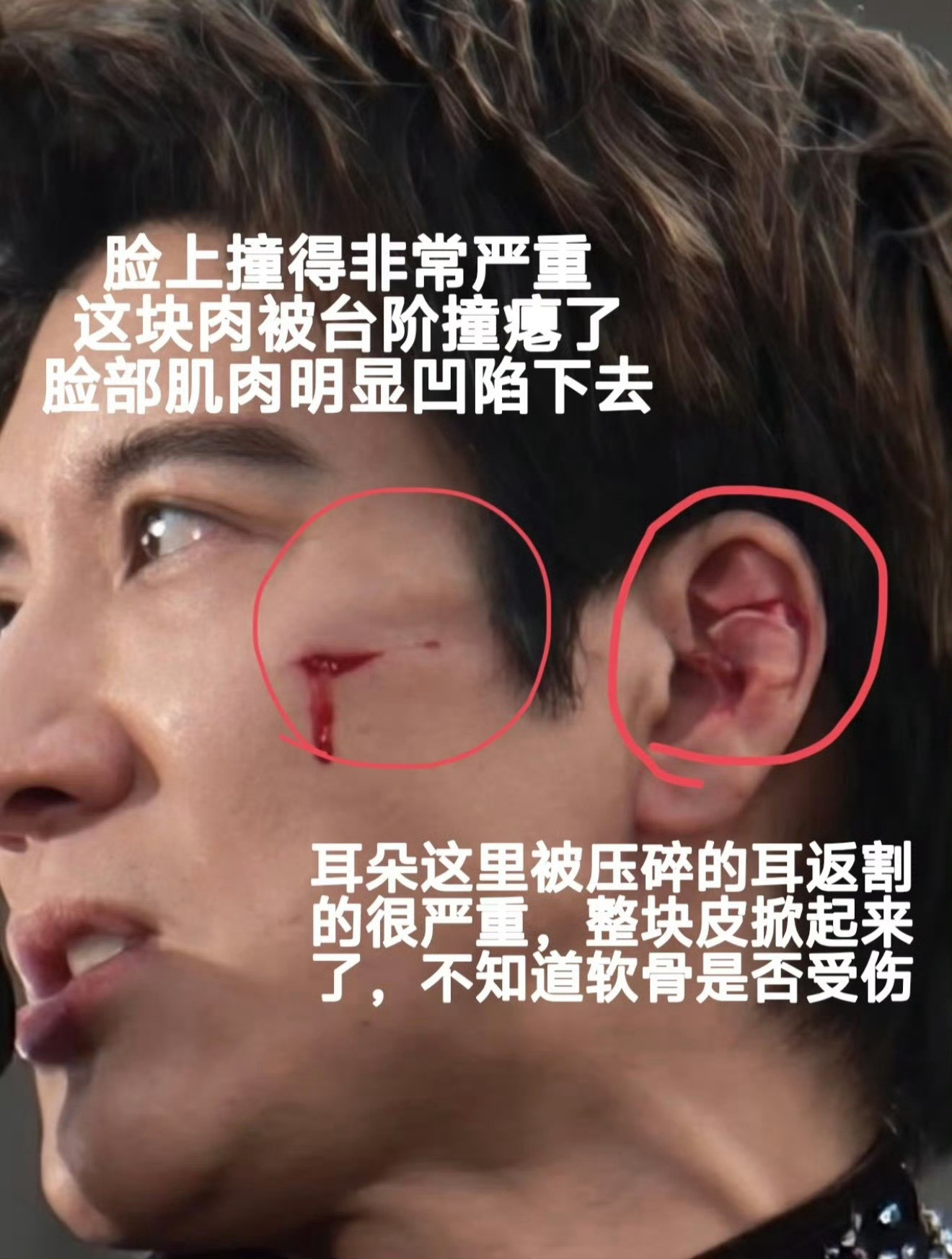 王力宏缝了39针都这样了，还继续演出，敬业值得点赞。这样的明星，比那些玩票来开演