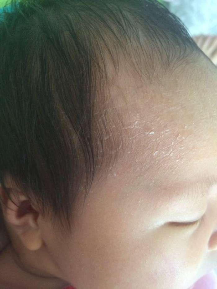 新手妈妈扣孩子头顶, 宝宝发烧整夜, 医生斥责不懂装懂