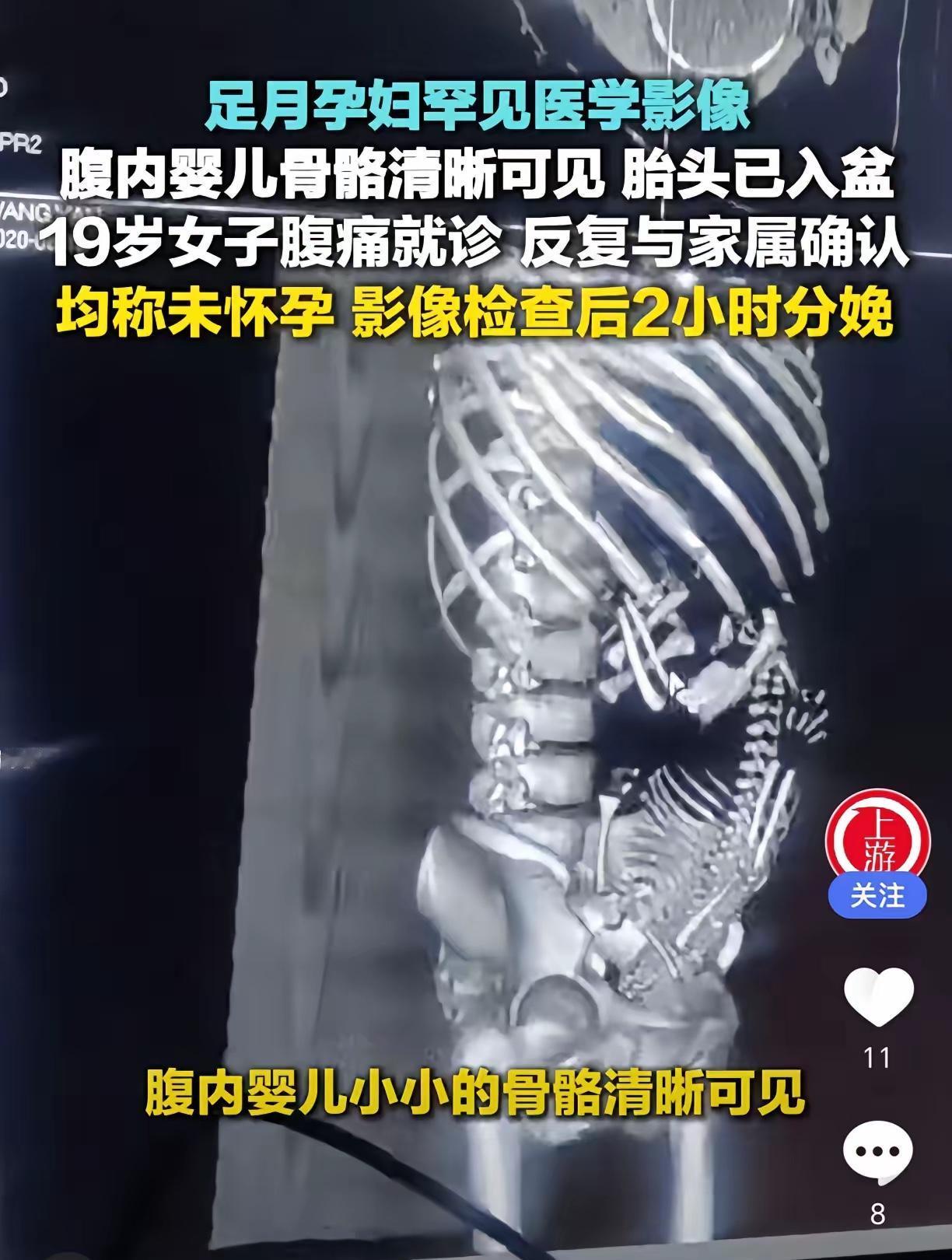 19岁女子腹痛去医院，医生反复跟她和家属确认是否怀孕，都得到否认答复。可影像检查