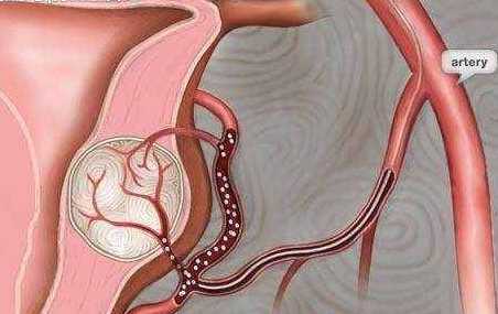 这3类食物女生特爱吃, 赶紧住手吧, 子宫肌瘤就是这样吃出来的!
