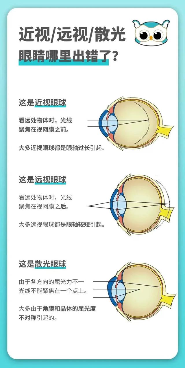 别懵圈! 用大白话讲清近视、远视、散光、裸眼视力与度数