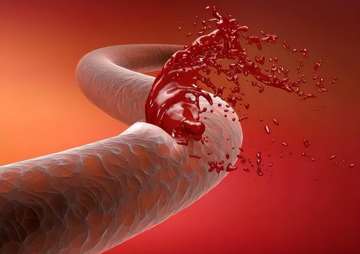 脑溢血发生前会有7个“前兆”，出现一个以上，需尽早就医脑溢血发生之前其实给过