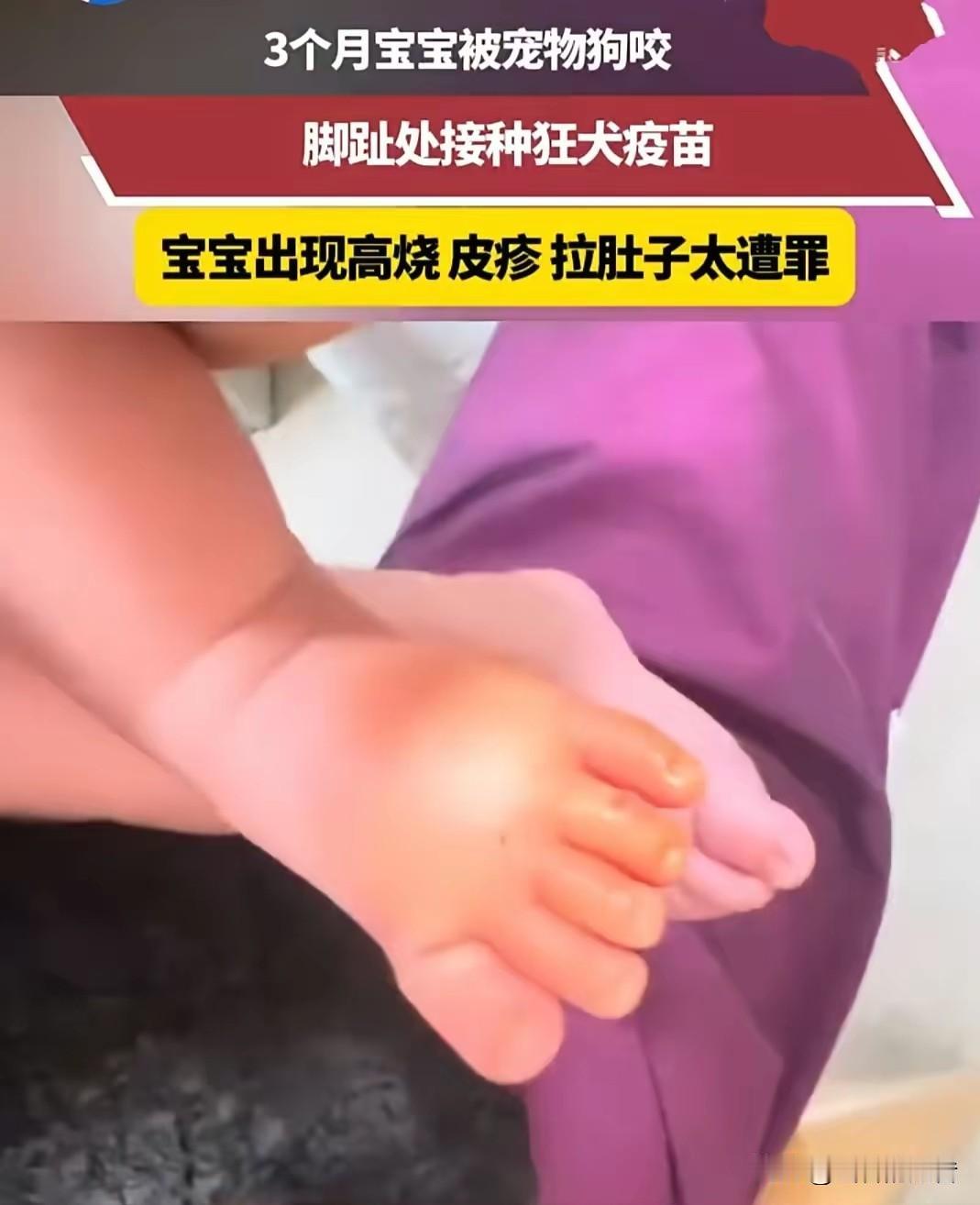 三月大婴儿喝奶被宠物狗咬伤，打完疫苗接连遭罪，宝妈彻底崩溃自责三个月大的宝