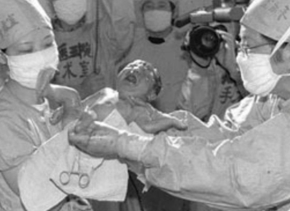 著名专家预言：试管婴儿寿命仅40年，那首例试管婴儿如今怎样了？“试管婴儿活不过