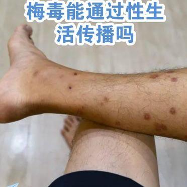 一篇科普文章明确列出了梅毒的四种主要传播方式。性接触。深吻。血液。母婴。大多