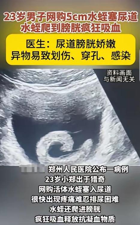 河南郑州，23岁小伙听信偏方，网购一条5cm水蛭塞进尿道，谁料，虫子钻进膀胱