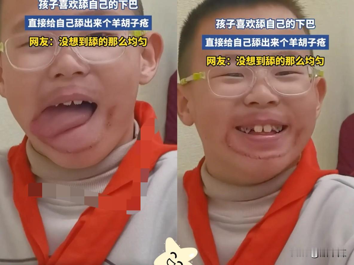 “这还能笑得出来？”浙江，一名男孩有个不太好的习惯，就是孩子喜欢舔自己的下巴，可