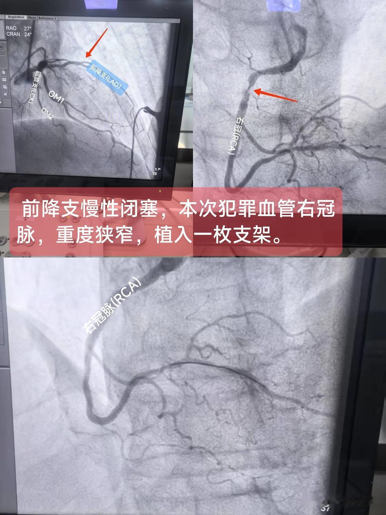 急性ST段抬高型心肌梗死（前降支慢性闭塞，本次犯罪血管右冠脉重度狭窄）一、概