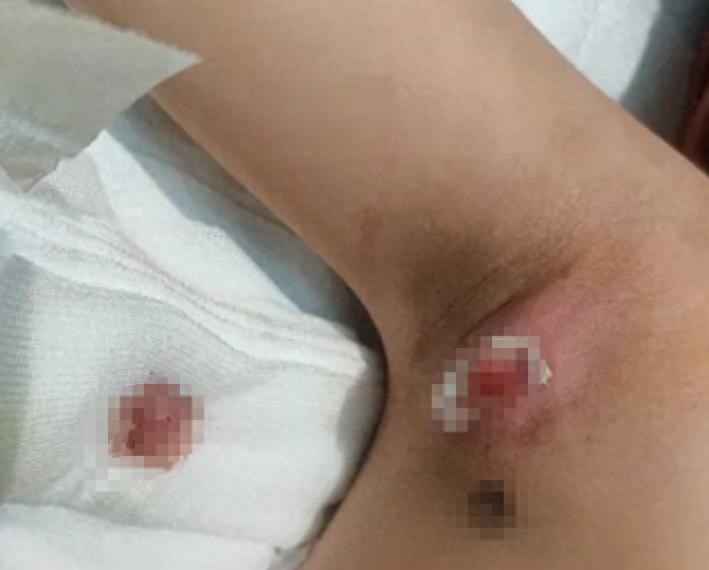 浙江杭州，5岁男孩航航右腋下冒出个“蚊子包”，谁料一个月竟疯长成鸡蛋大，疼得连手