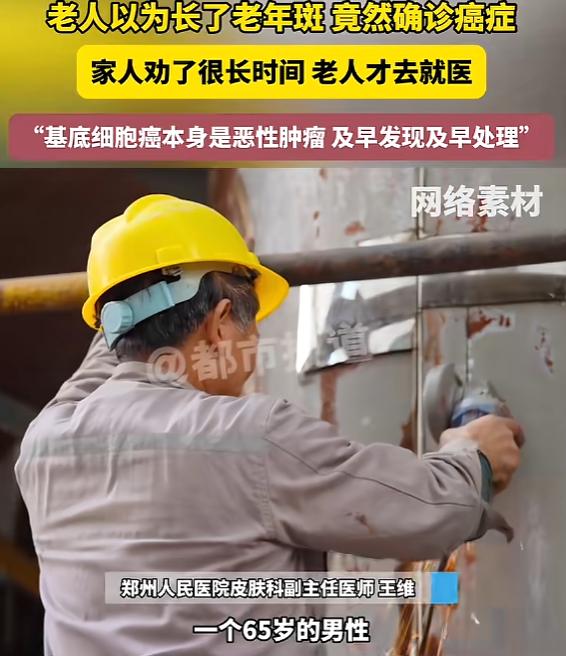 “太吓人了！”河南郑州，一大爷脸上长了个褐色斑块，一直以为是普通老年斑，压根没当