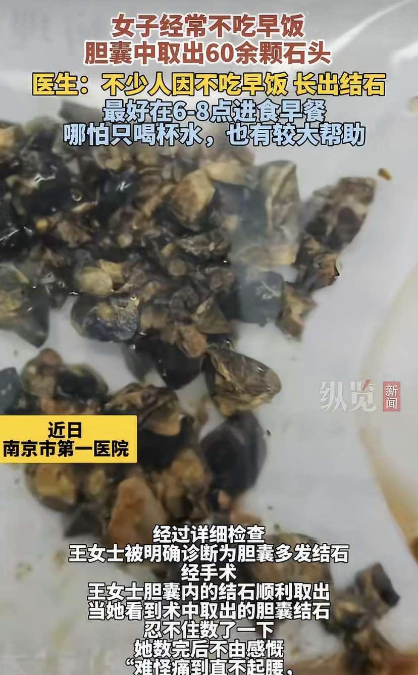 太吓人！3月3日，南京35岁女子聚餐后肚子剧痛，去医院一查，医生从她体内取出这玩