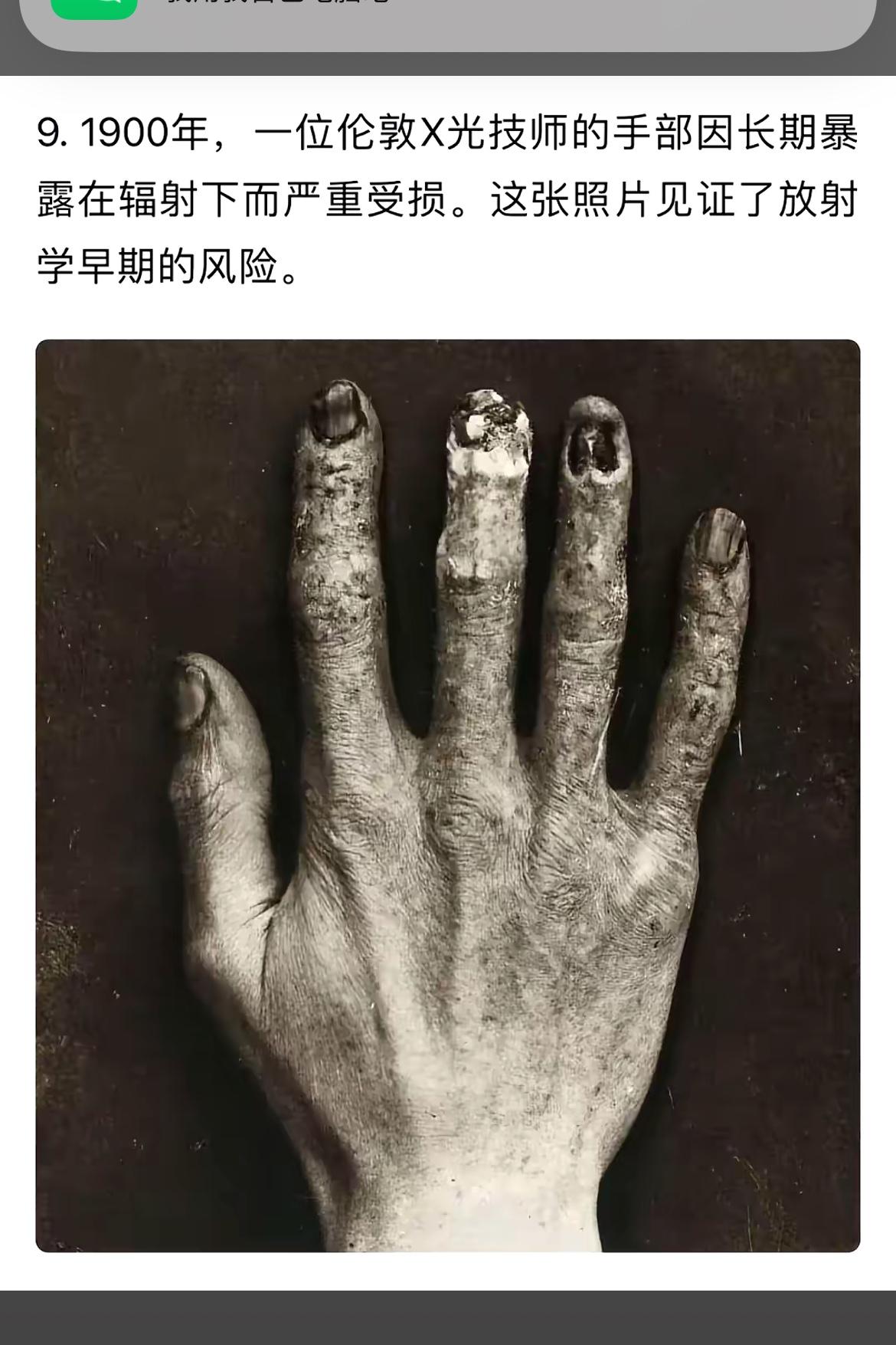 1900年X光技师手部损伤，见证放射学早期风险
