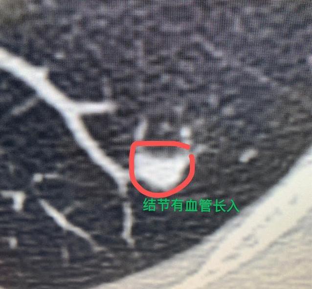 一旦查出大于1cm的肺部实性结节，临床上处理方式一定要格外谨慎！所有超过1c