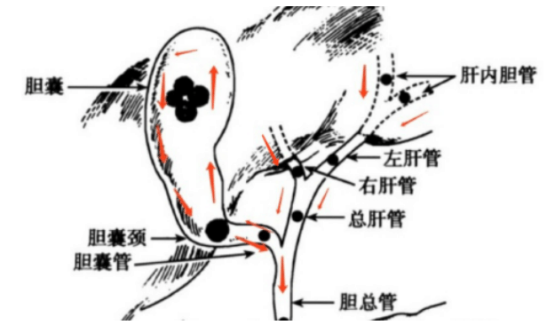 结石困扰着越来越多的人, 该怎么办才好?